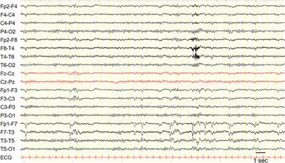 Epilepsy With Auditory Features: From Etiology to Treatment